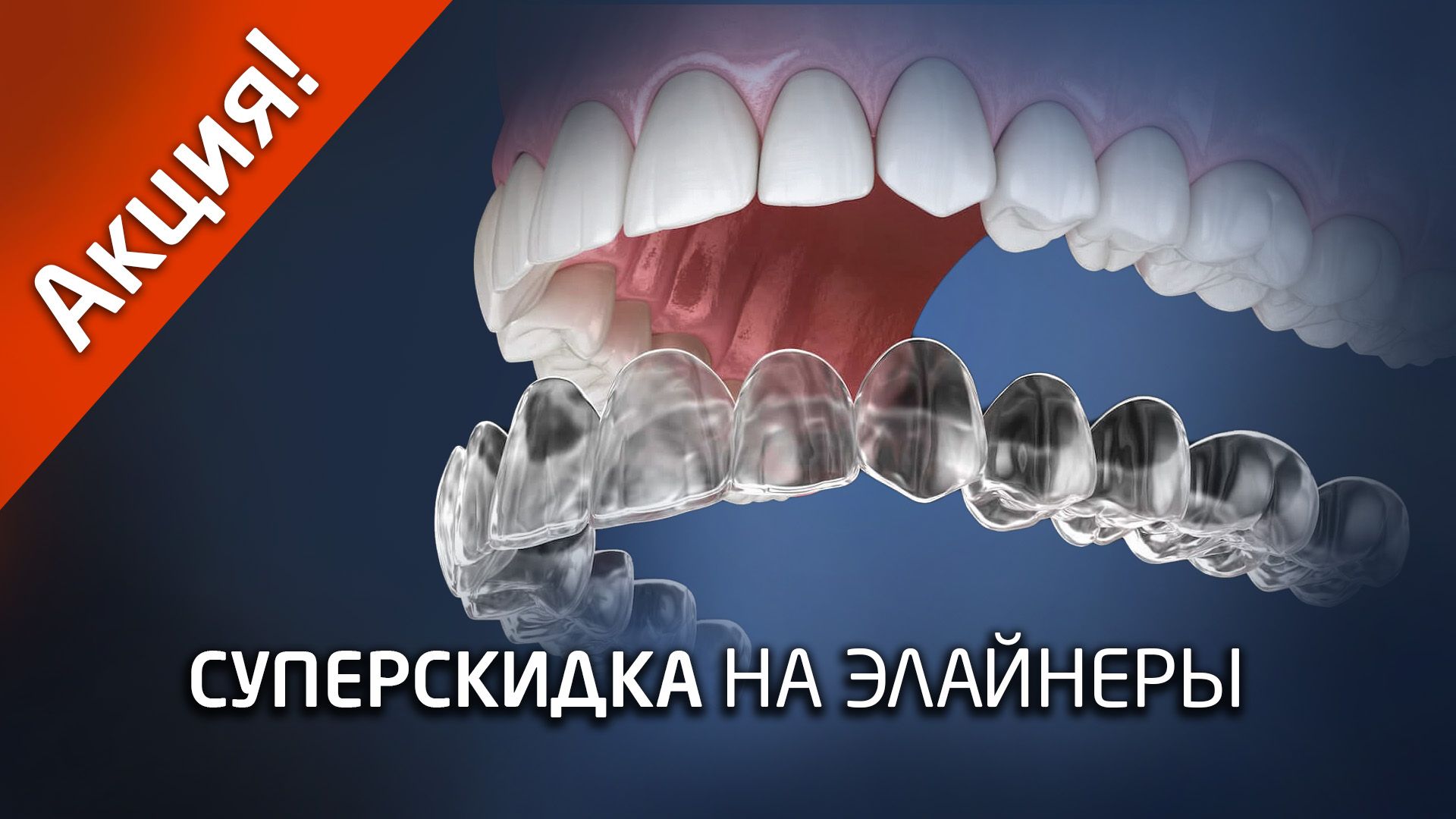 clear-aligners