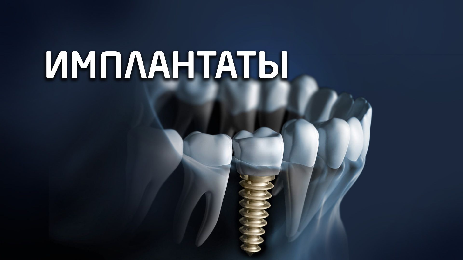 dental-implant-prosthetics