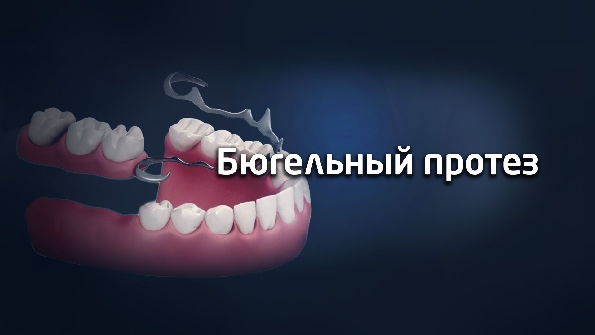 partial-dentures